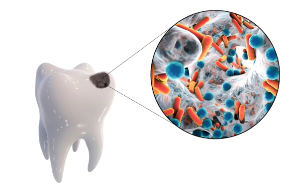 How do bacteria make cavities image